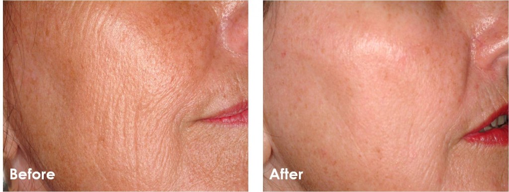 Before and after Fractionated Laser Skin Resurfacing