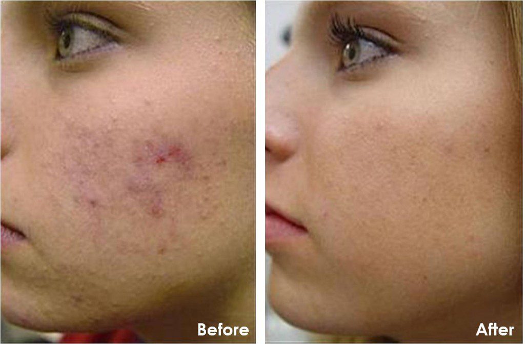 Before and after Micropeel Plus photos