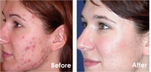 Before and after Photodynamic Therapy