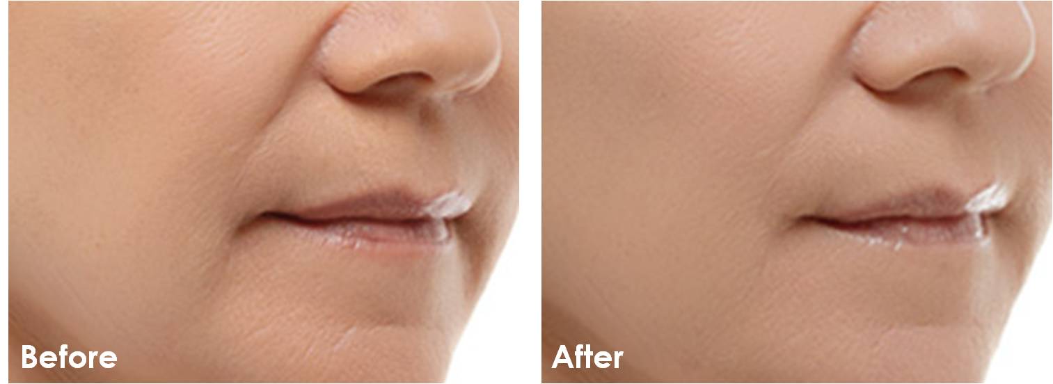Before and after Radiesse treatments