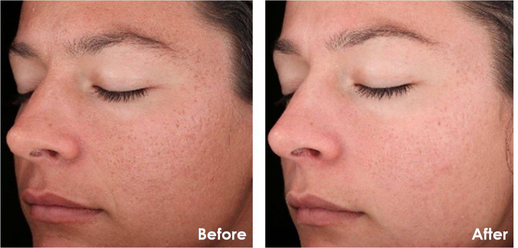 Rejuvenize Peel™ before and after photos