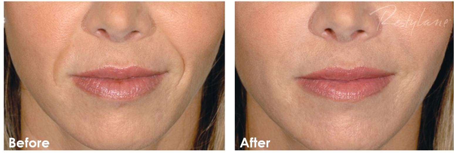 Before and after Restylane Defyne treatments