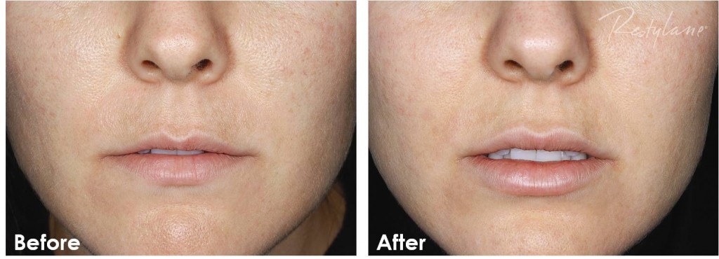 Before and after Restylane Refyne photos