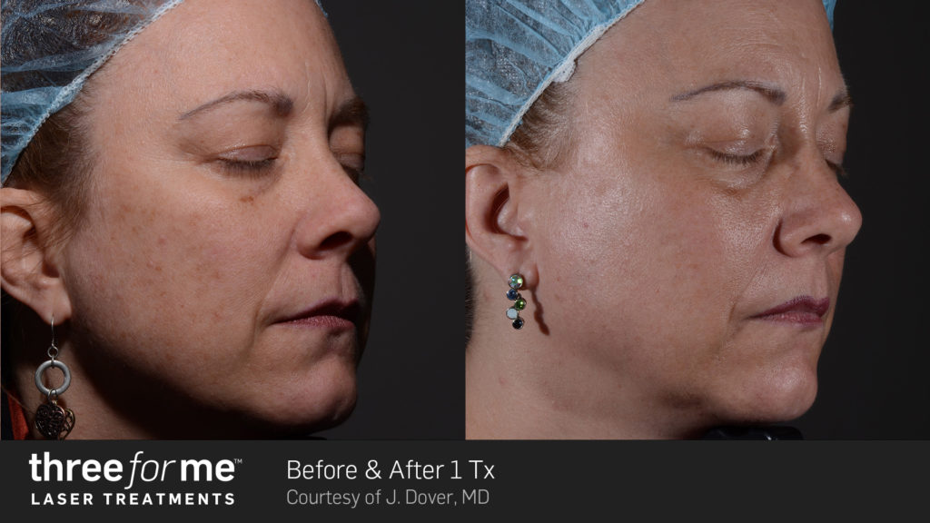 Before and after ThreeForMe treatments