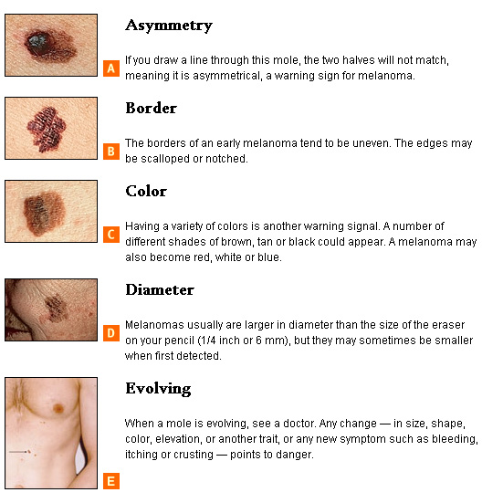 ABCs of Skin Cancer