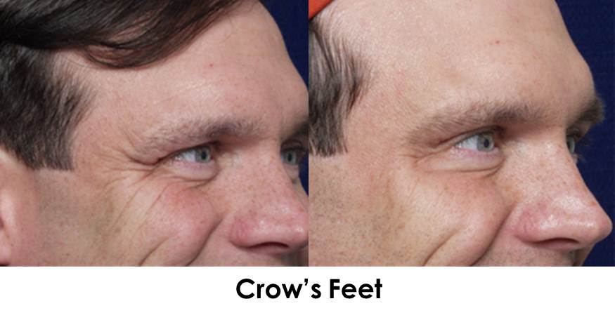 Botox-crows-feet