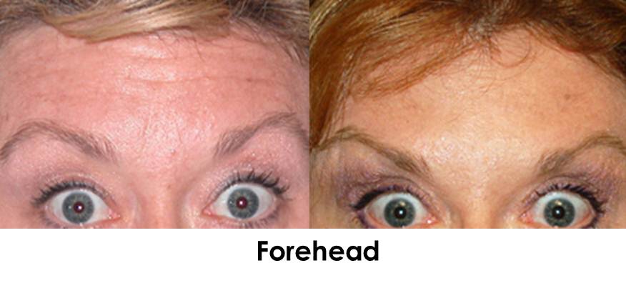 Botox-forehead