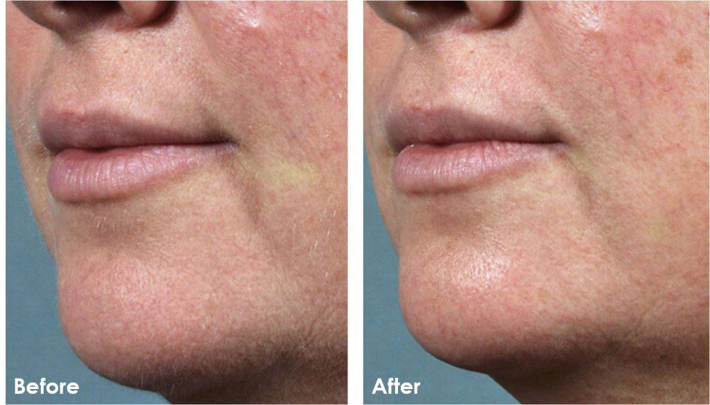Dermaplaning before and after results