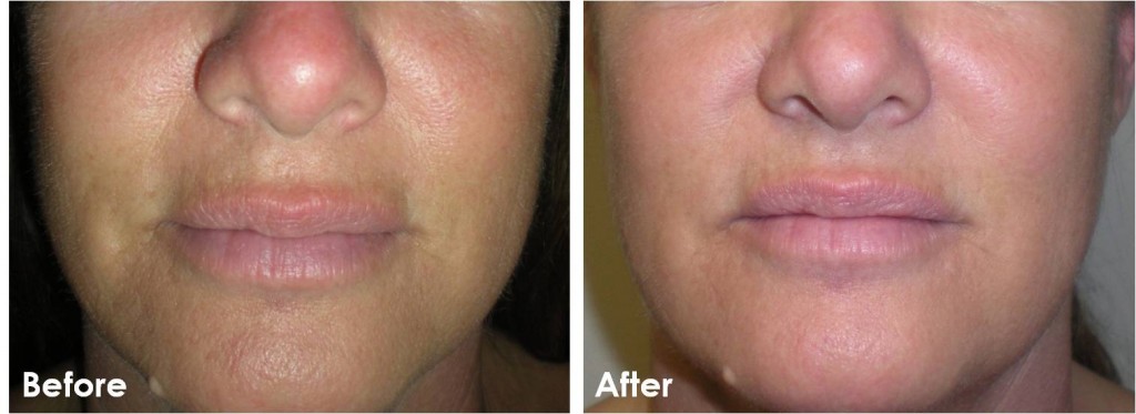 Microdermabrasion before and after results