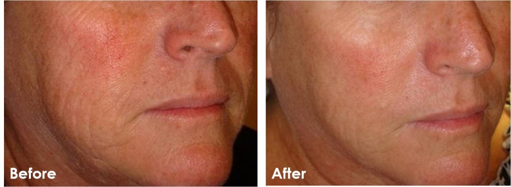 Microinfusion before and after photos