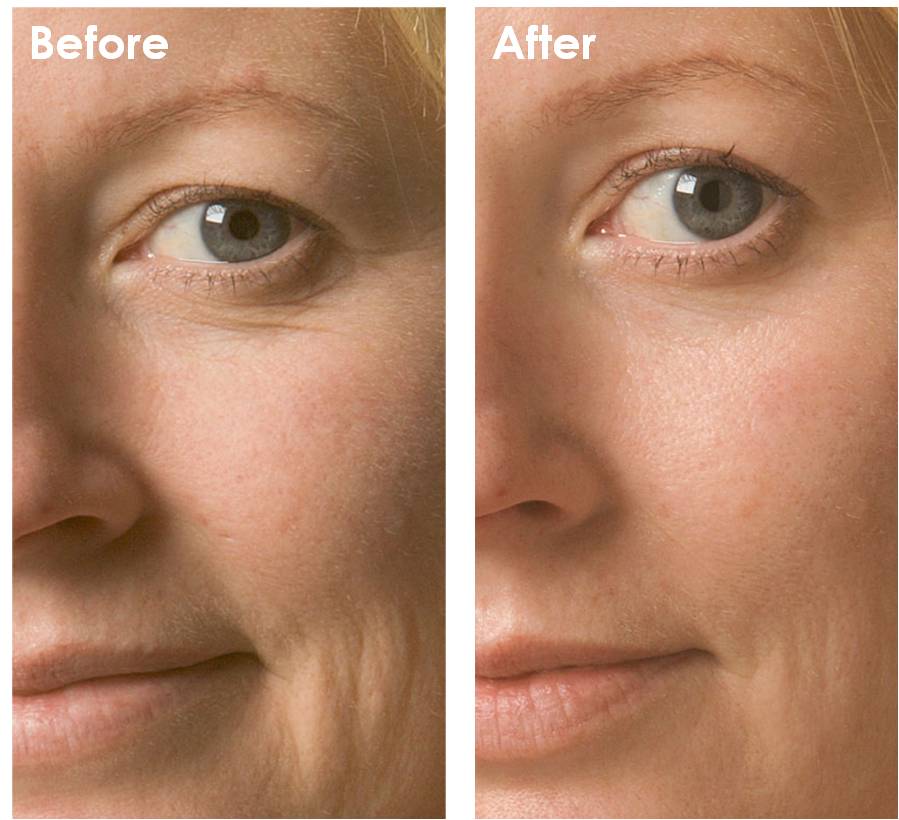 Intraceuticals Oxygen Facial before and after results