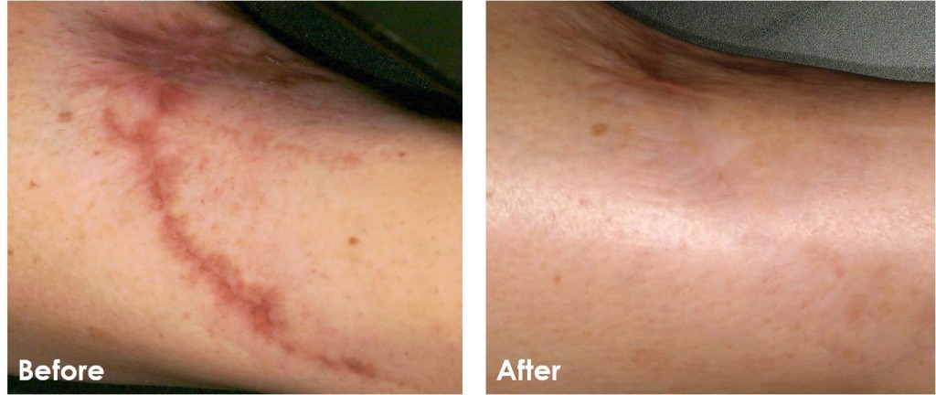 Scar and Stretch Mark Therapy before and after photos