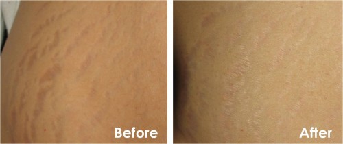 Scar and Stretch Mark Therapy before and after results