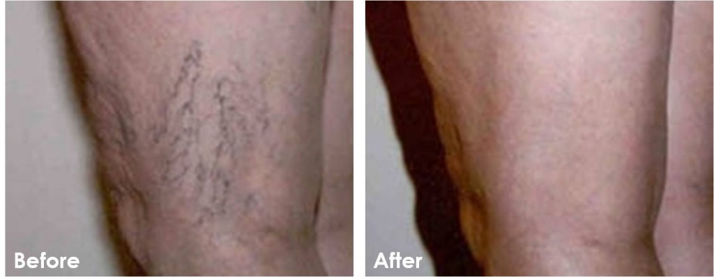 Before and after Sclerotherapy photos